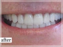 After Image: Smile Makeover - front