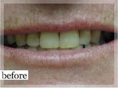 Before Image: Smile Makeover - front