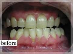 Before Image: Smile Makeover - front