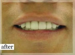 After Image: Smile Makeover - front