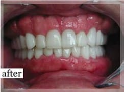 After Image: Smile Makeover - front