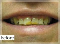 Before Image: Smile Makeover - front