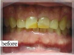 Before Image: Smile Makeover - front