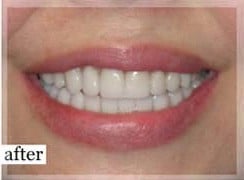 After Image: Smile Makeover - front