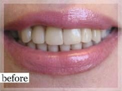 Before Image: Smile Makeover - front