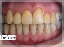 Before Image: Smile Makeover - front