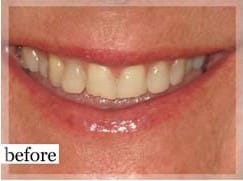 Before Image: Smile Makeover - front