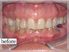 Before Image: Smile Makeover - front