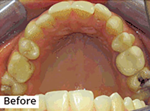 Before Image: Smile Makeover - front