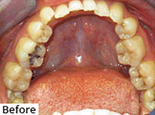 Before Image: Smile Makeover -