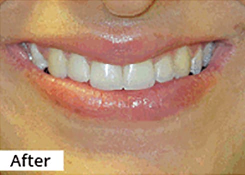 After Image: Smile Makeover - front