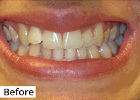 Before Image: Smile Makeover - front