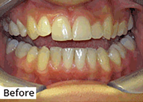 Before Image: Smile Makeover - front