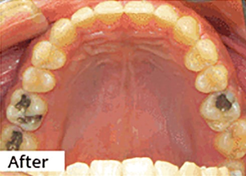 After Image: Smile Makeover - front