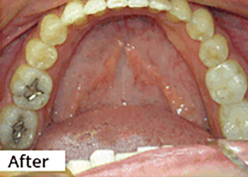 After Image: Smile Makeover - front