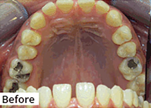 Before Image: Smile Makeover - front