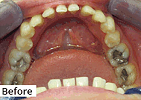 Before Image: Smile Makeover - front