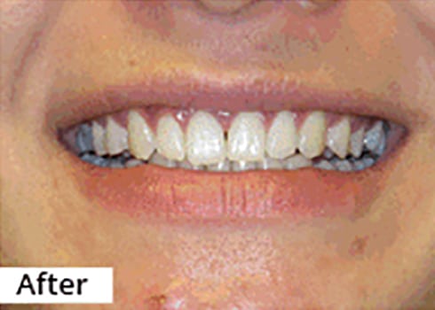 After Image: Smile Makeover - front