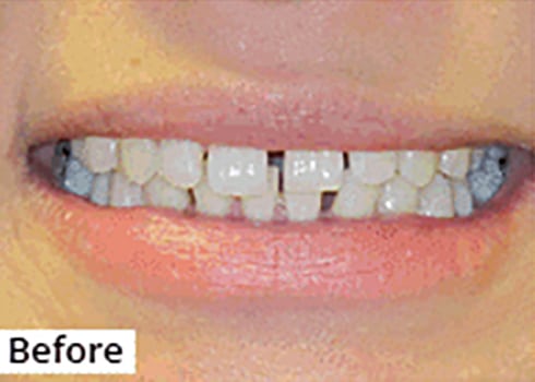 Before Image: Smile Makeover - front