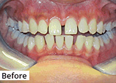 Before Image: Smile Makeover -