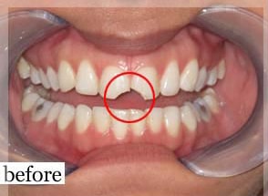 Before Image: Smile Makeover - front