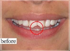 Before Image: Smile Makeover - front