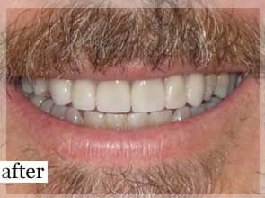 After Image: Smile Makeover - front