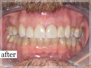 After Image: Smile Makeover - front