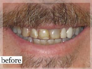 Before Image: Smile Makeover - front