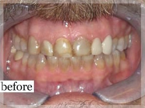 Before Image: Smile Makeover - front