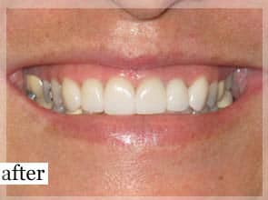 After Image: Smile Makeover - front