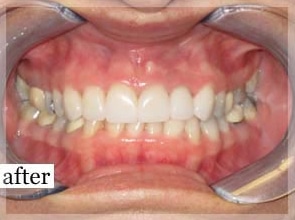 After Image: Smile Makeover - front