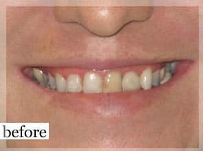 Before Image: Smile Makeover - front