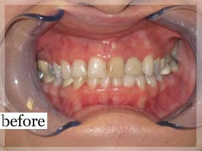 Before Image: Smile Makeover - front