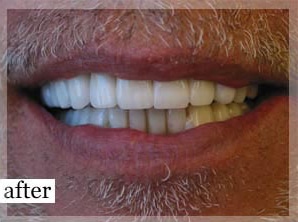 After Image: Smile Makeover - front