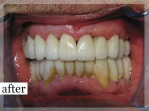 After Image: Smile Makeover - front