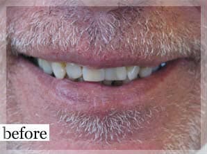 Before Image: Smile Makeover - front