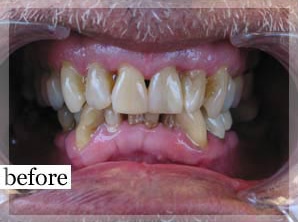 Before Image: Smile Makeover - front