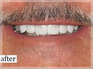 After Image: Smile Makeover - front