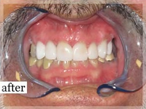 After Image: Smile Makeover - front