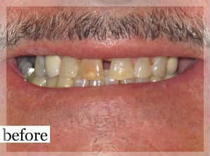 Before Image: Smile Makeover - front