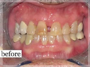 Before Image: Smile Makeover - front