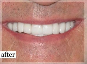 After Image: Smile Makeover - front