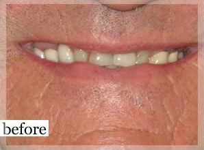 Before Image: Smile Makeover - front