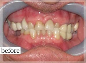 Before Image: Smile Makeover - front