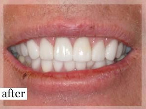 After Image: Smile Makeover - front