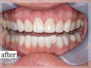 After Image: Smile Makeover - front