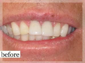 Before Image: Smile Makeover - front