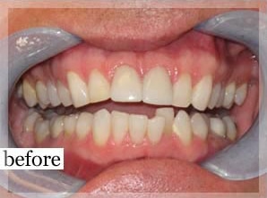 Before Image: Smile Makeover - front