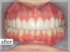 After Image: Smile Makeover - front